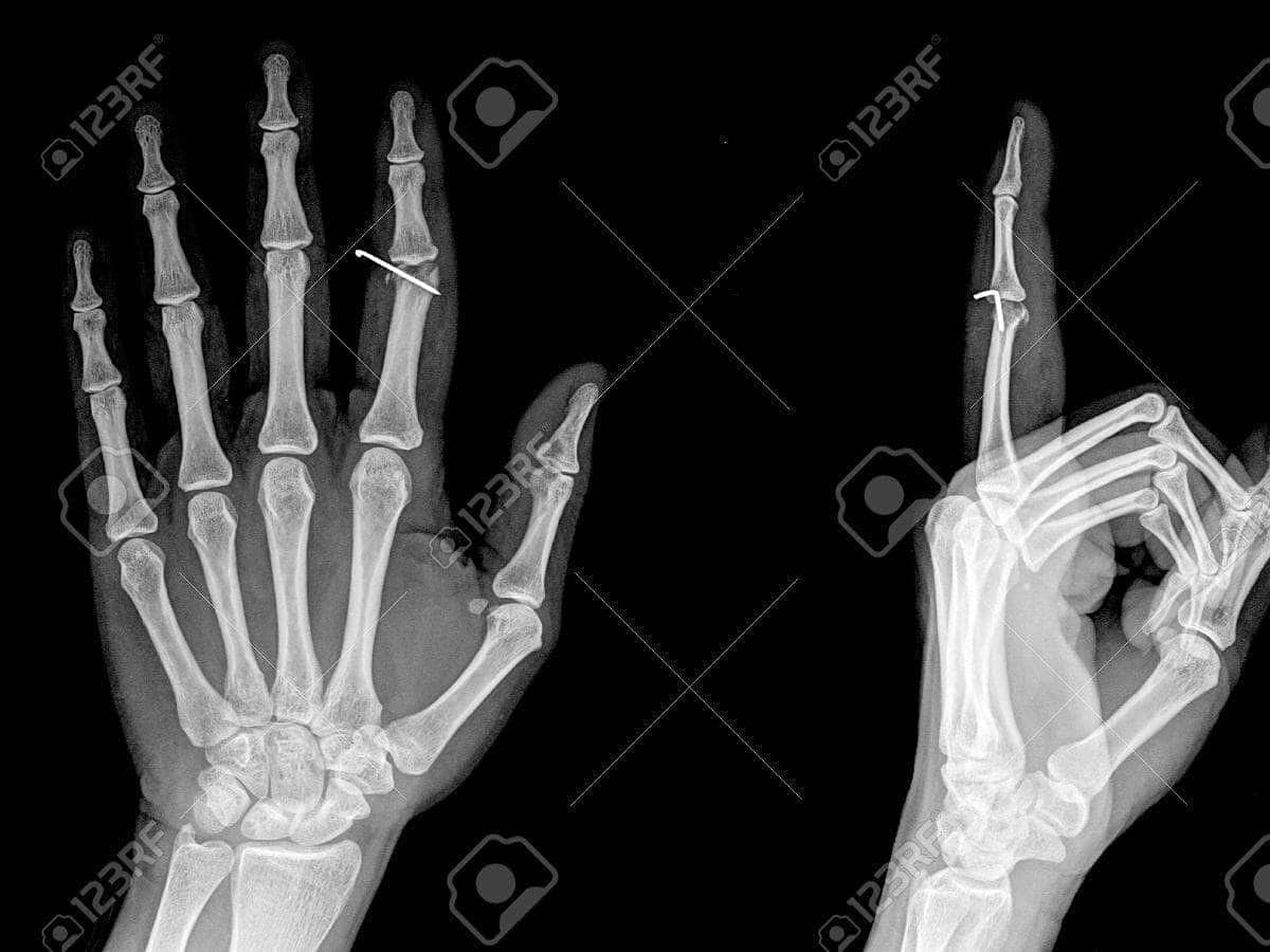 radiografia del dedo