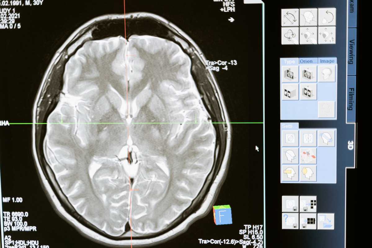 Elon Musk dice que Neuralink implantó por primera vez un chip cerebral en un humano