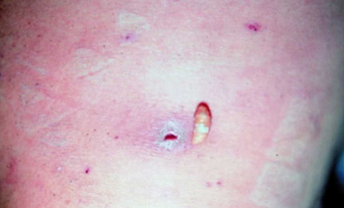 Costa Rica reporta su primer caso de gusano barrenador en humanos